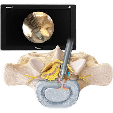 脊椎脊髄の手術 = Illustrated Surgery of Spine … Anterior spine surgery - Morgenstern Institute of Spine